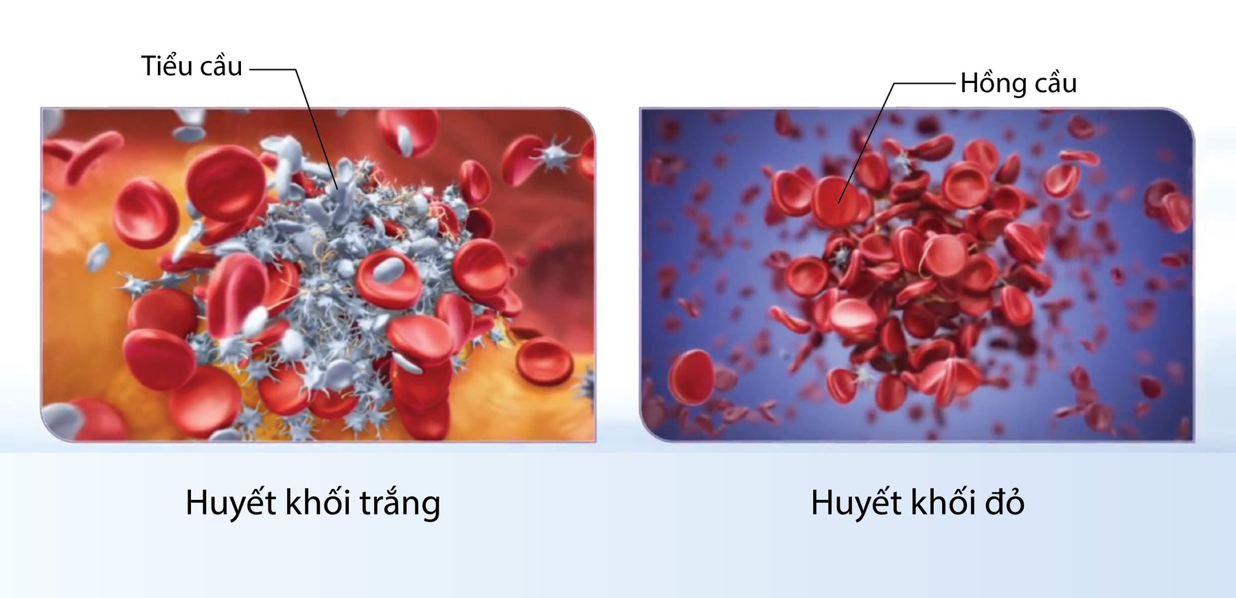 Huyết khối là gì và cơ chế hình thành | Vinmec